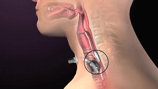 Clinical Complications of Tracheostomy
